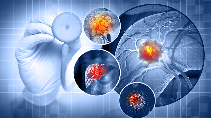 Understanding Hepatocellular Carcinoma: Diagnosis and Staging