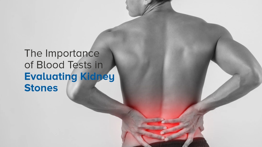 The Importance of Blood Tests in Evaluating Kidney Stones