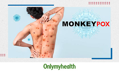 Is Monkeypox More Prevalent In LGBTQ Community? Doctors Comment